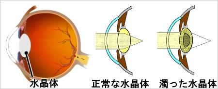 白内障とは