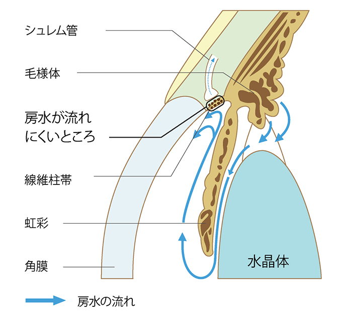 原発開放隅角緑内障