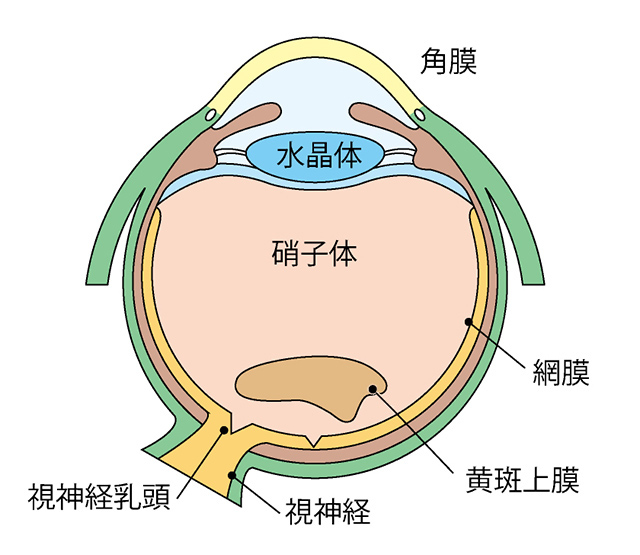 黄斑前膜（黄斑上膜）